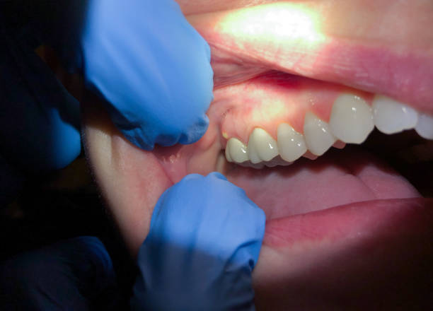 Best Emergency Tooth Extraction in Woodbury, TN