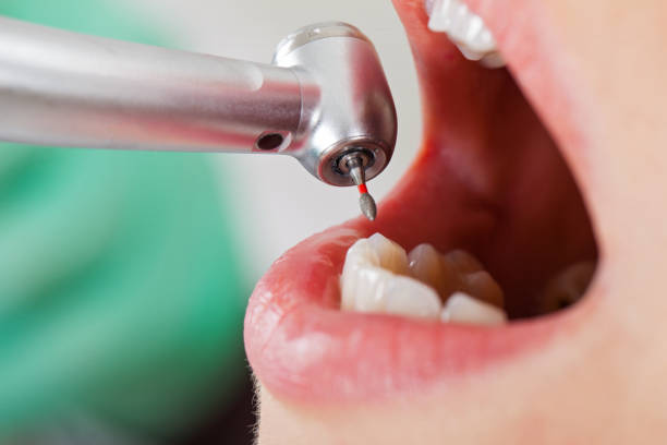 Best Emergency Root Canal Treatment in Woodbury, TN